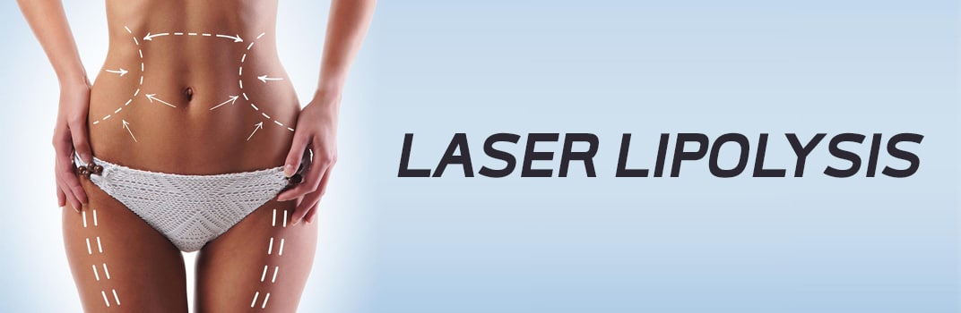 laser lipolysis