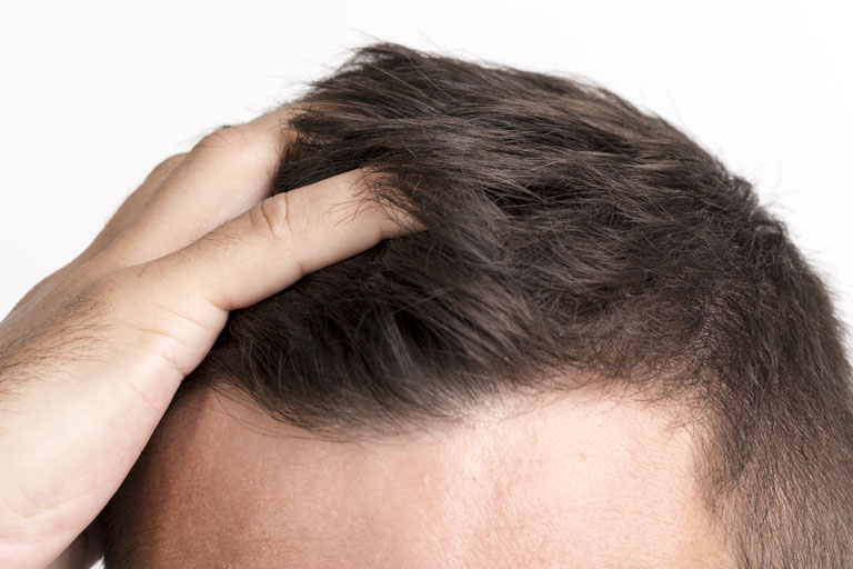 what causes hair thinning